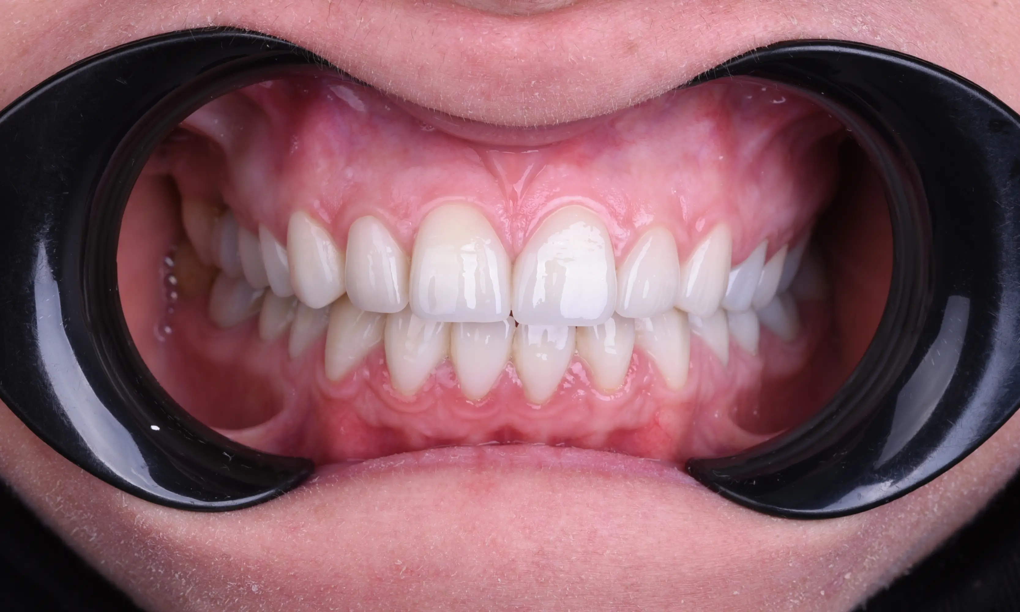 Full Veneers Sonrası - Vaka 40 - Milim Dental Hospital Bursa