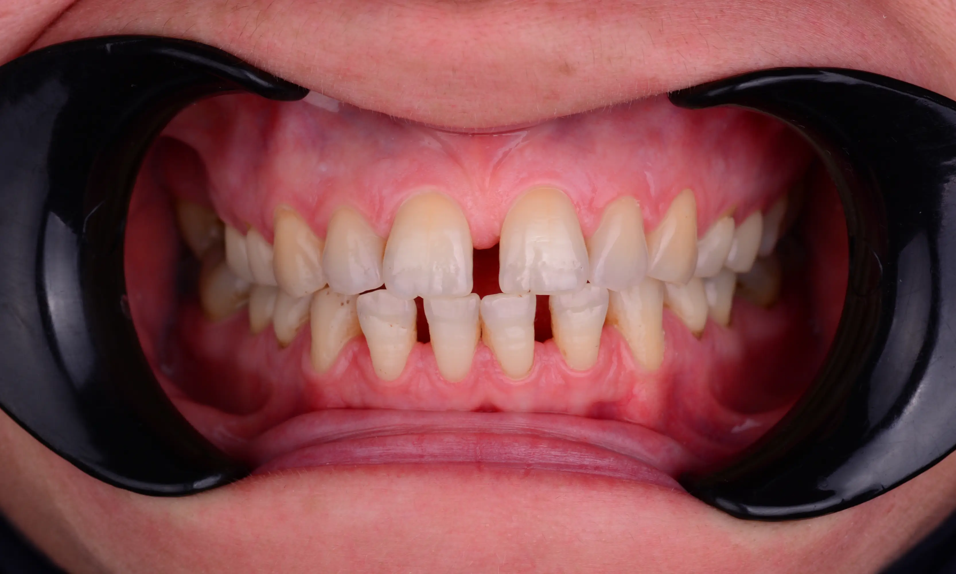 Full Veneers Öncesi - Vaka 40 - Milim Dental Hospital Bursa