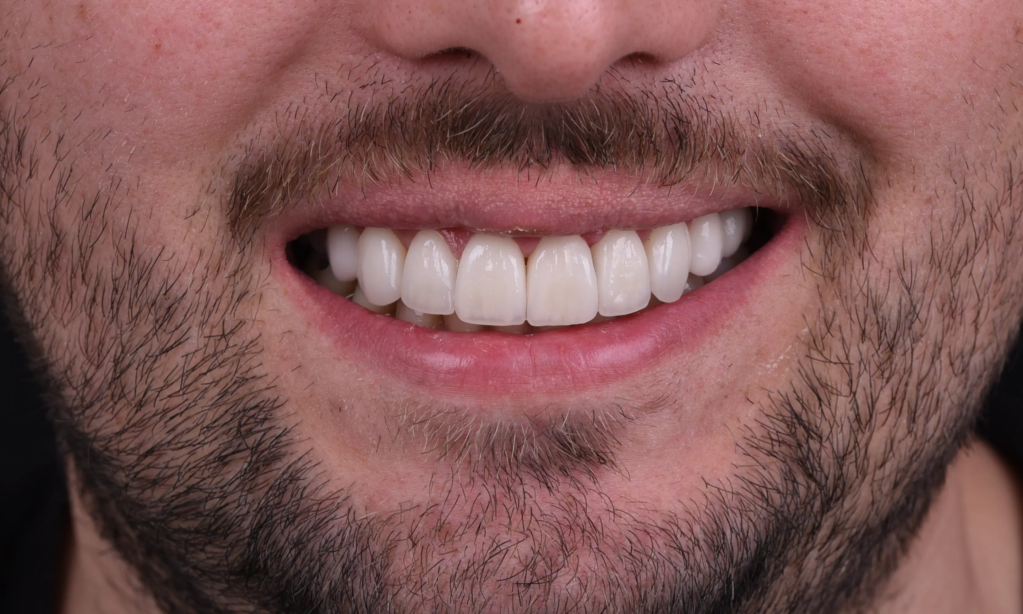 Full Veneers Sonrası - Vaka 42 - Milim Dental Hospital Bursa