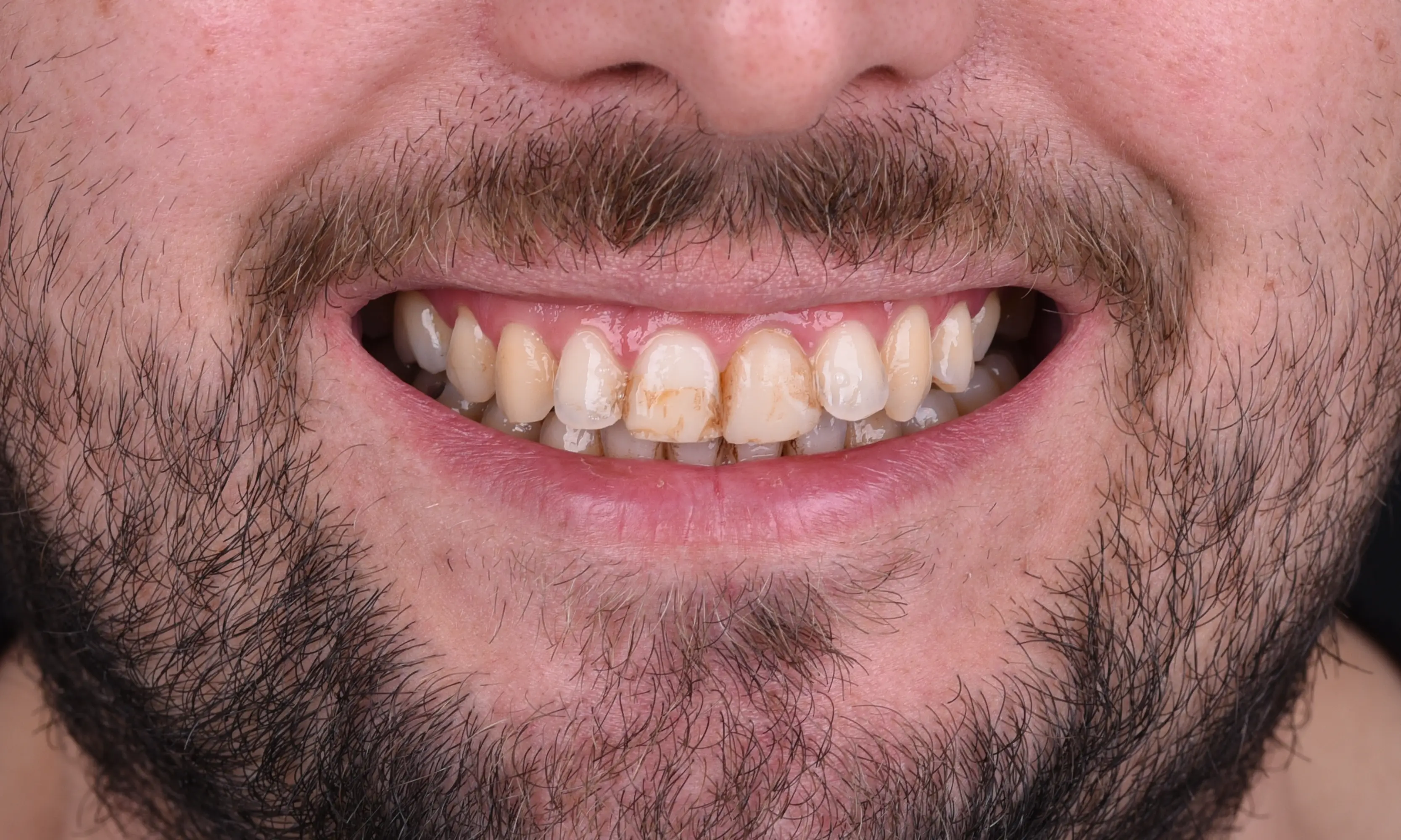 Full Veneers Öncesi - Vaka 42 - Milim Dental Hospital Bursa
