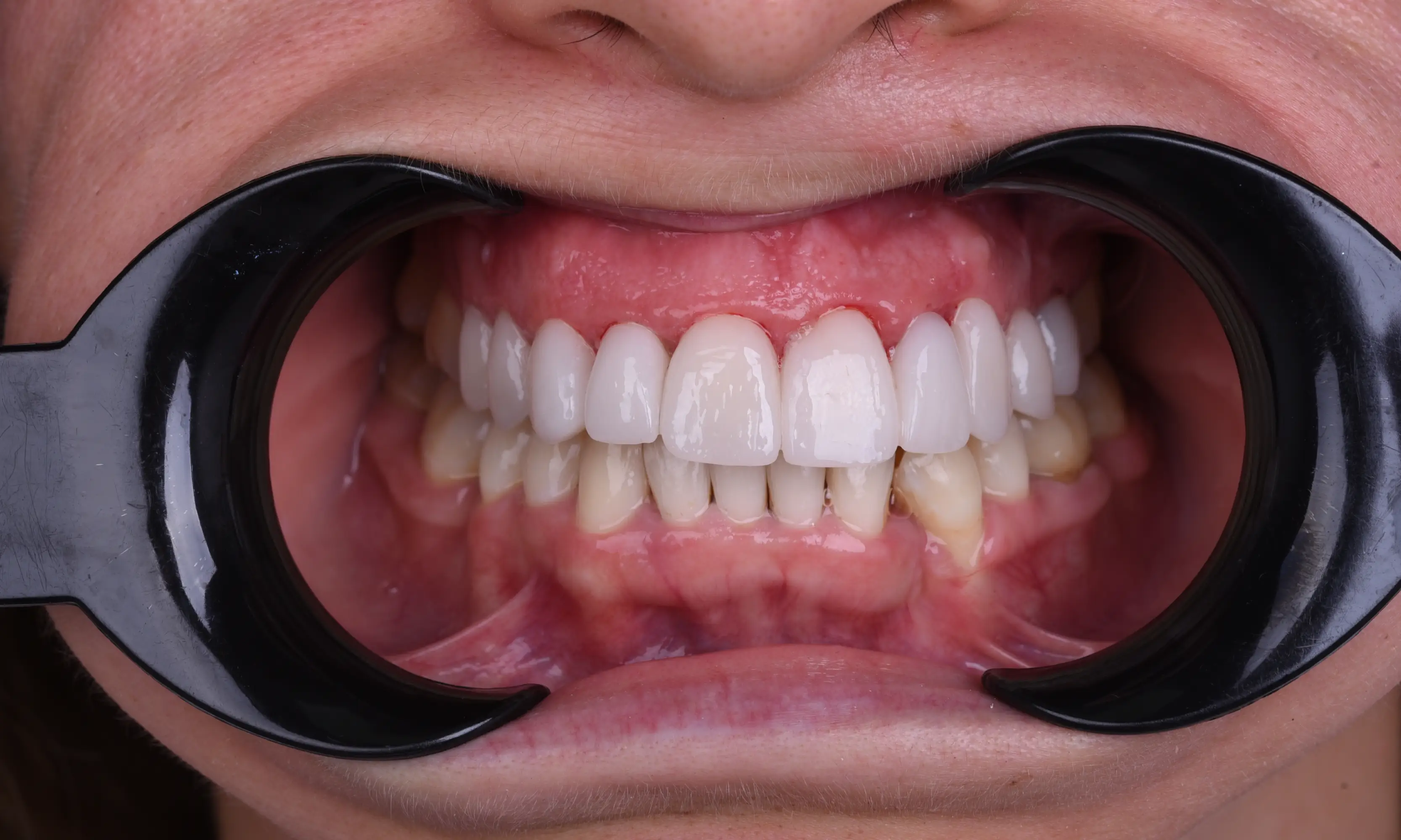 Full Veneers Sonrası - Vaka 45 - Milim Dental Hospital Bursa