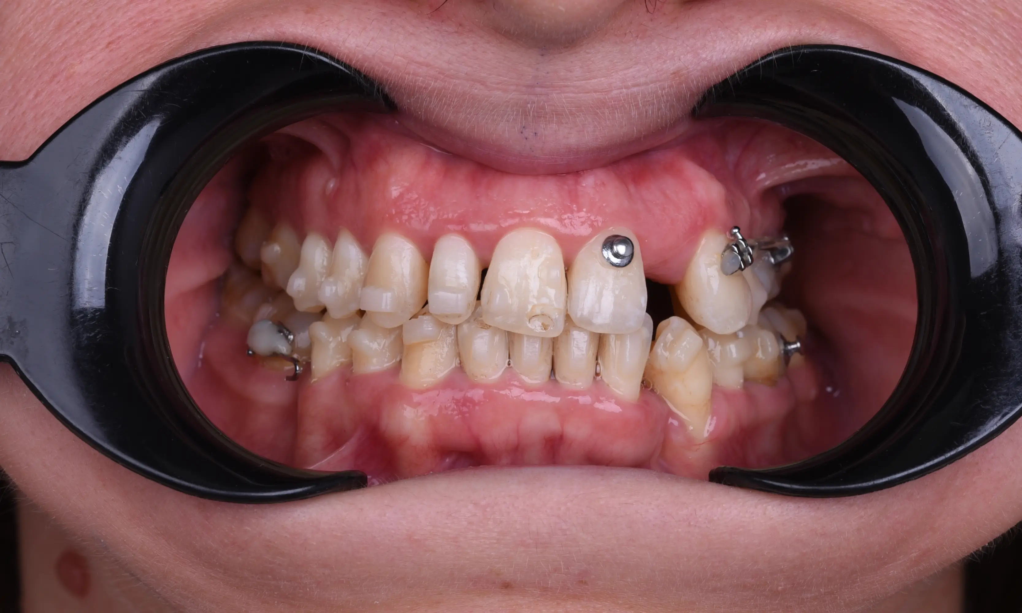 Full Veneers Öncesi - Vaka 45 - Milim Dental Hospital Bursa