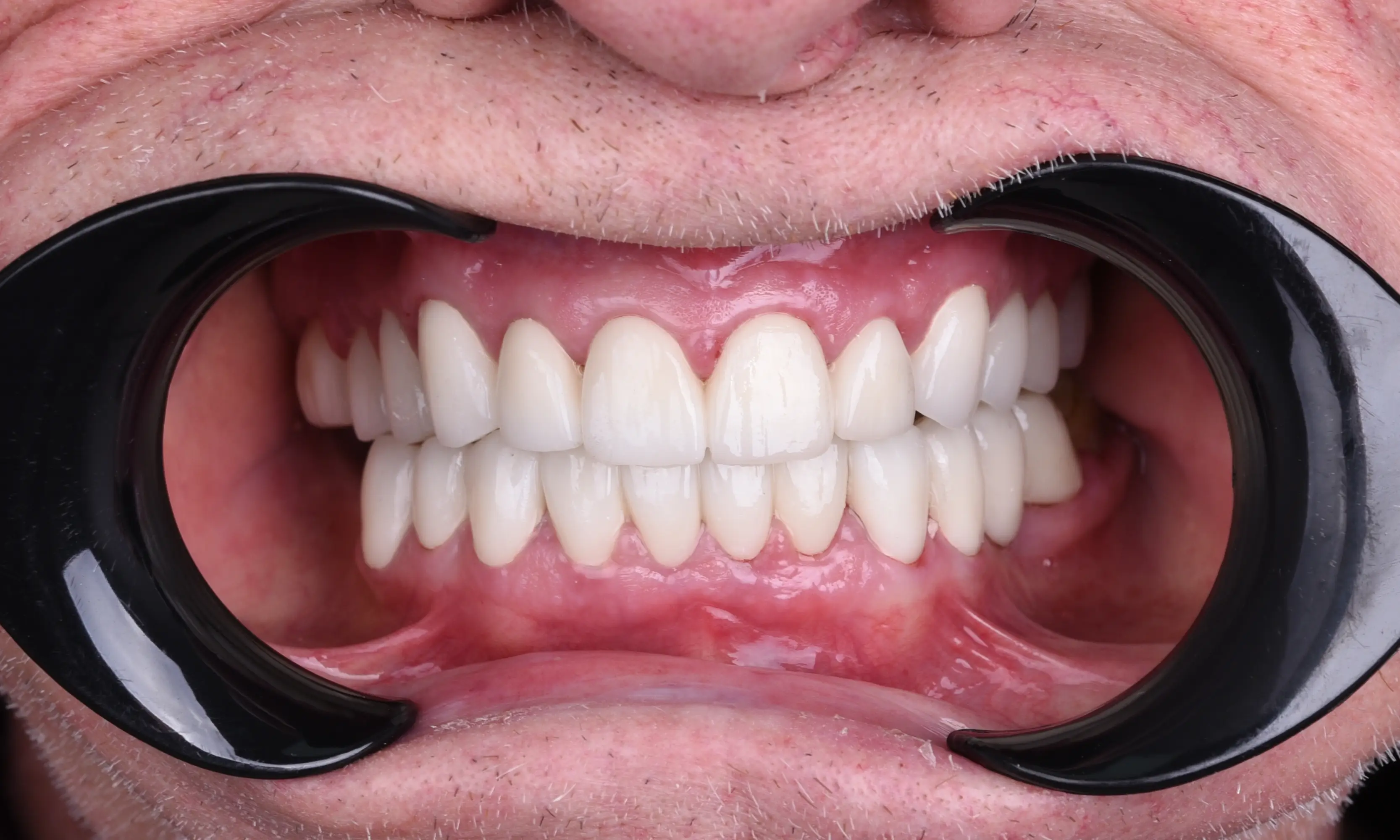 Full Veneers Sonrası - Vaka 49 - Milim Dental Hospital Bursa