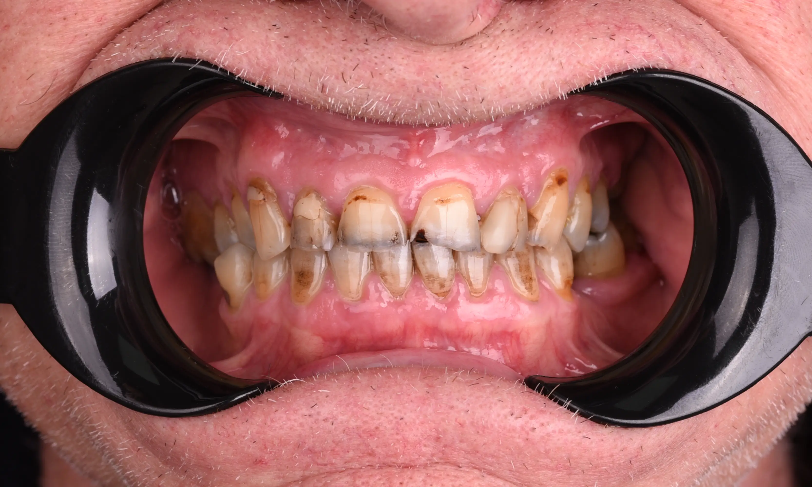 Full Veneers Öncesi - Vaka 49 - Milim Dental Hospital Bursa
