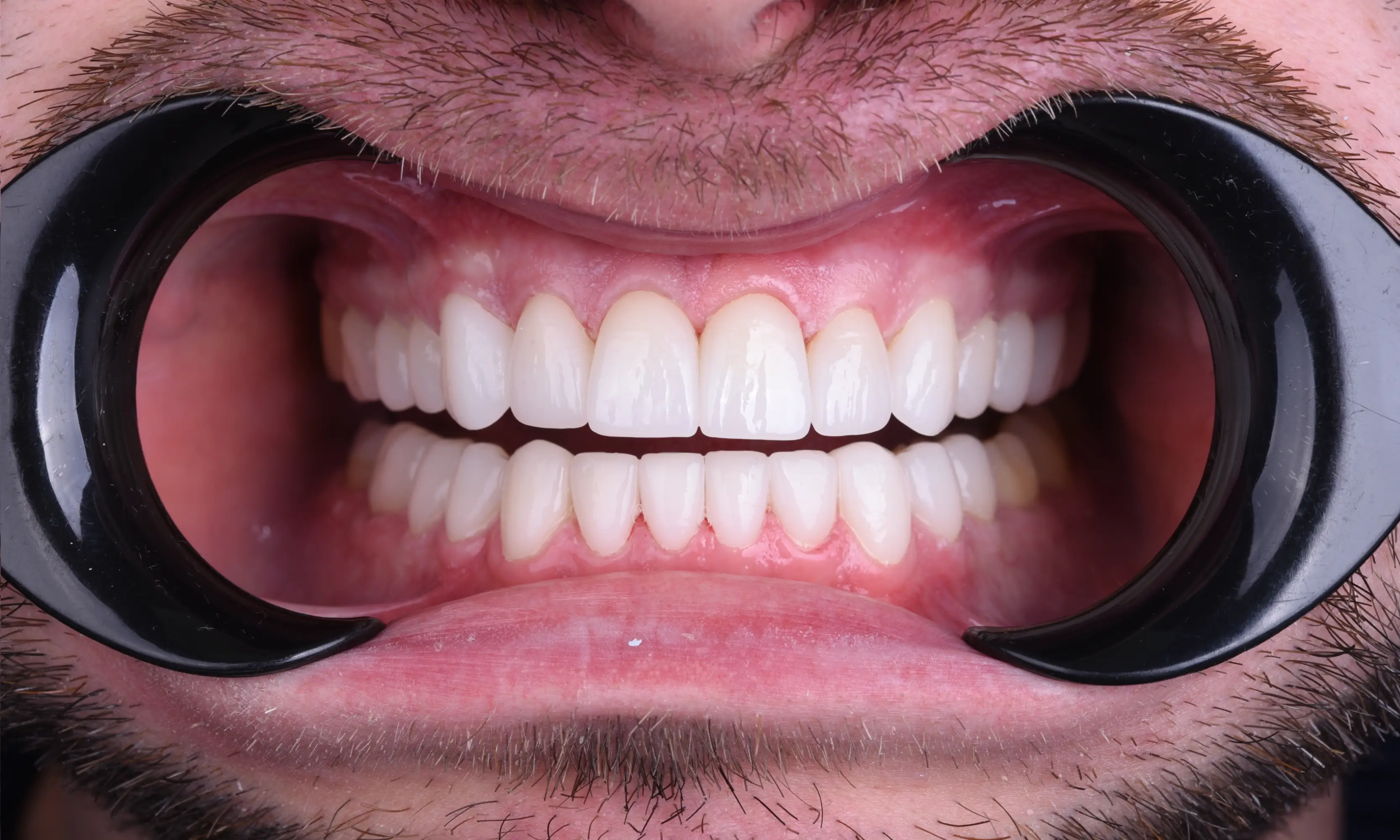 Full Veneers Sonrası - Vaka 50 - Milim Dental Hospital Bursa
