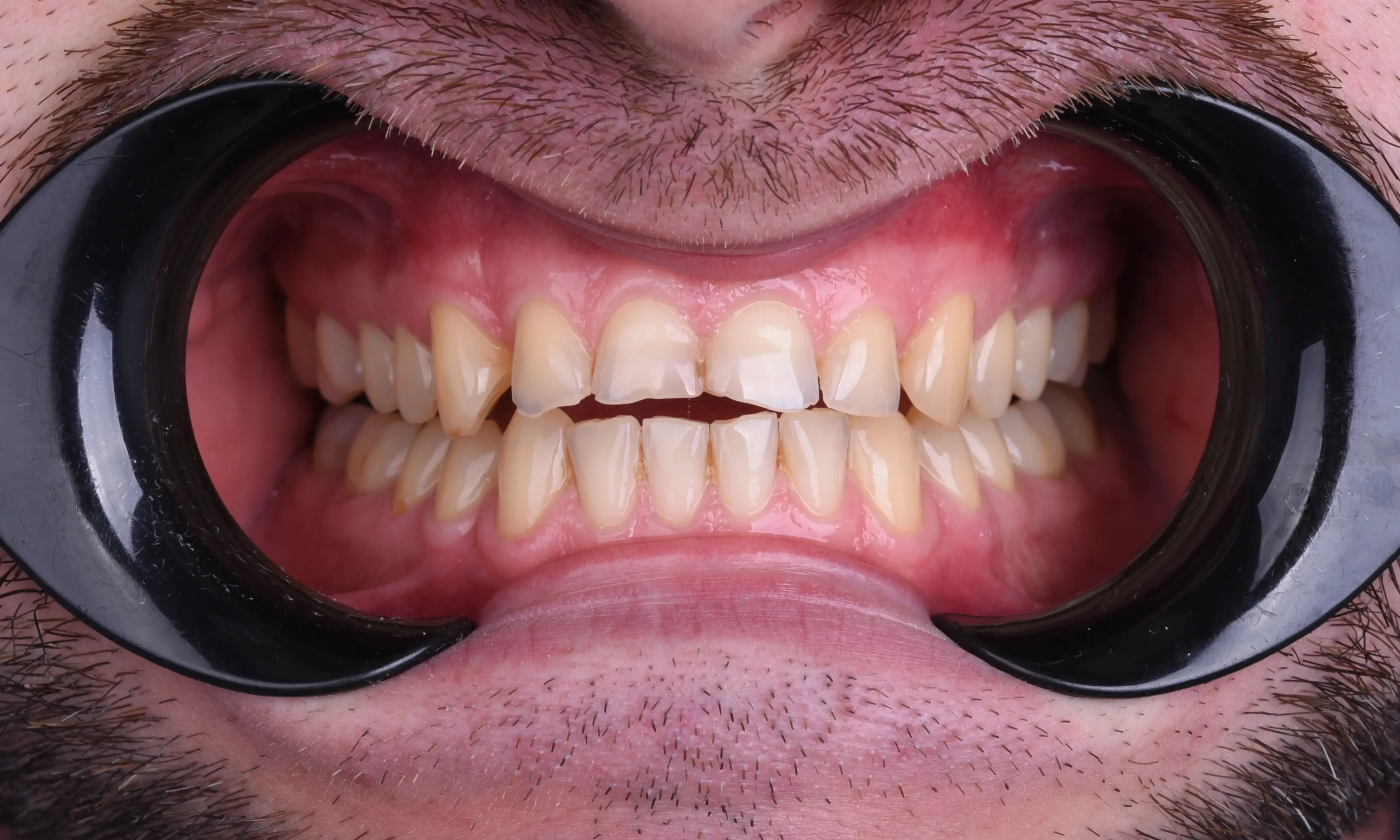 Full Veneers Öncesi - Vaka 50 - Milim Dental Hospital Bursa