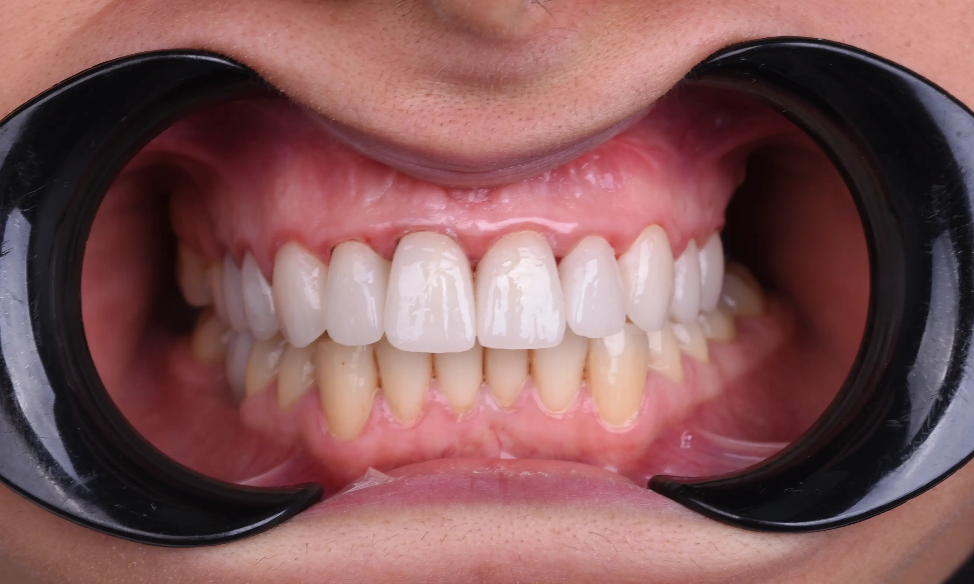 Tam Zirkonyum Sonrası - Vaka 56 - Milim Dental Hospital Bursa
