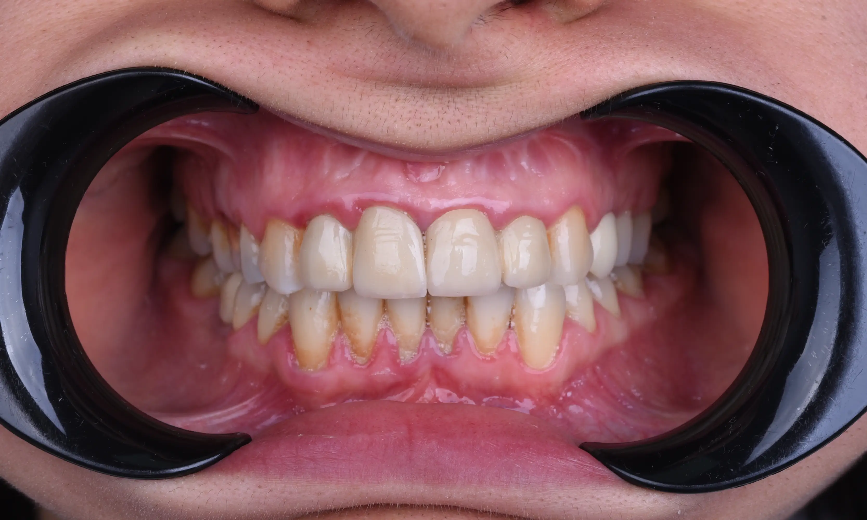 Tam Zirkonyum Öncesi - Vaka 56 - Milim Dental Hospital Bursa