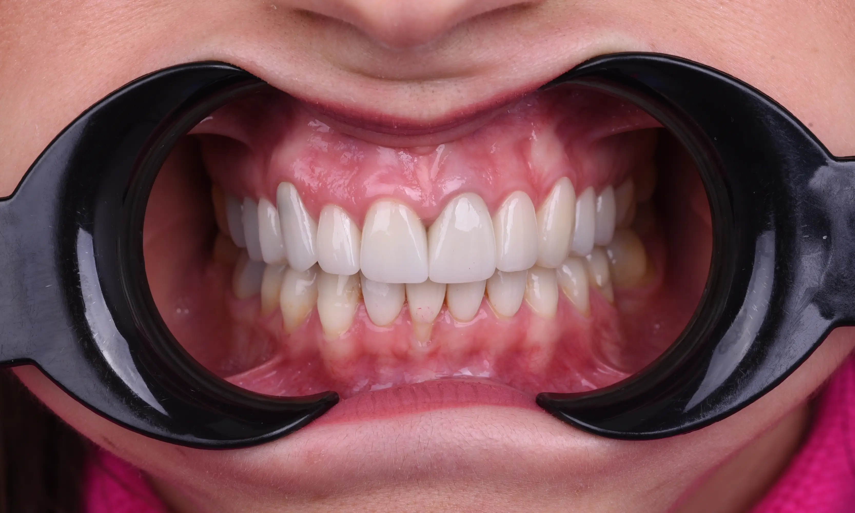 Tam Zirkonyum Sonrası - Vaka 57 - Milim Dental Hospital Bursa