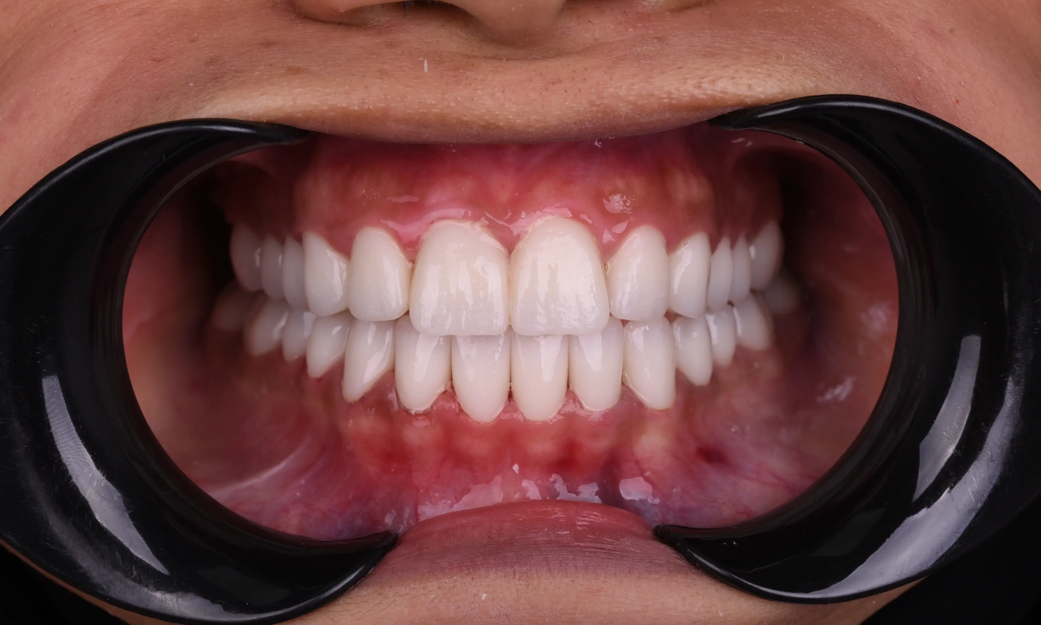 Tam Zirkonyum Sonrası - Vaka 63 - Milim Dental Hospital Bursa