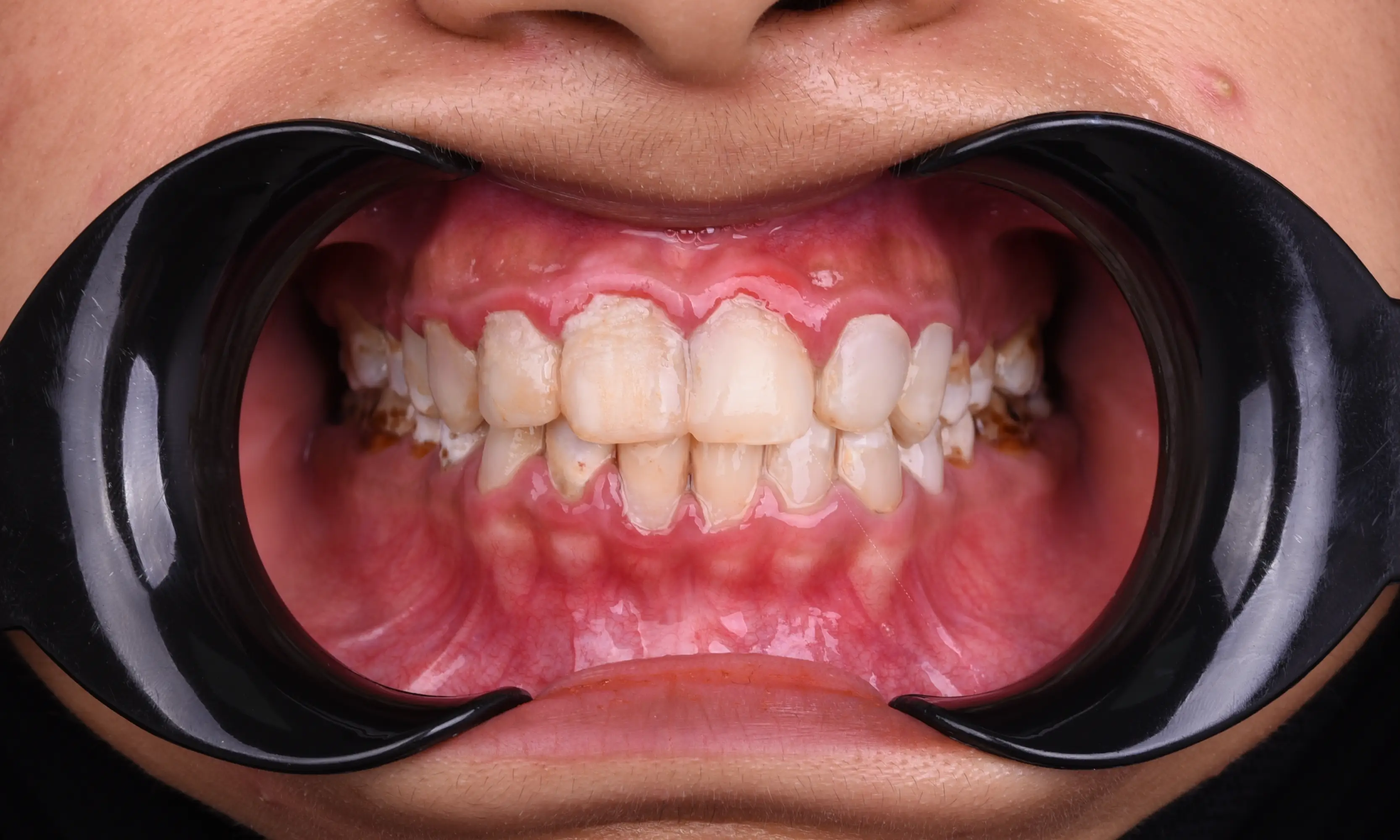 Tam Zirkonyum Öncesi - Vaka 63 - Milim Dental Hospital Bursa