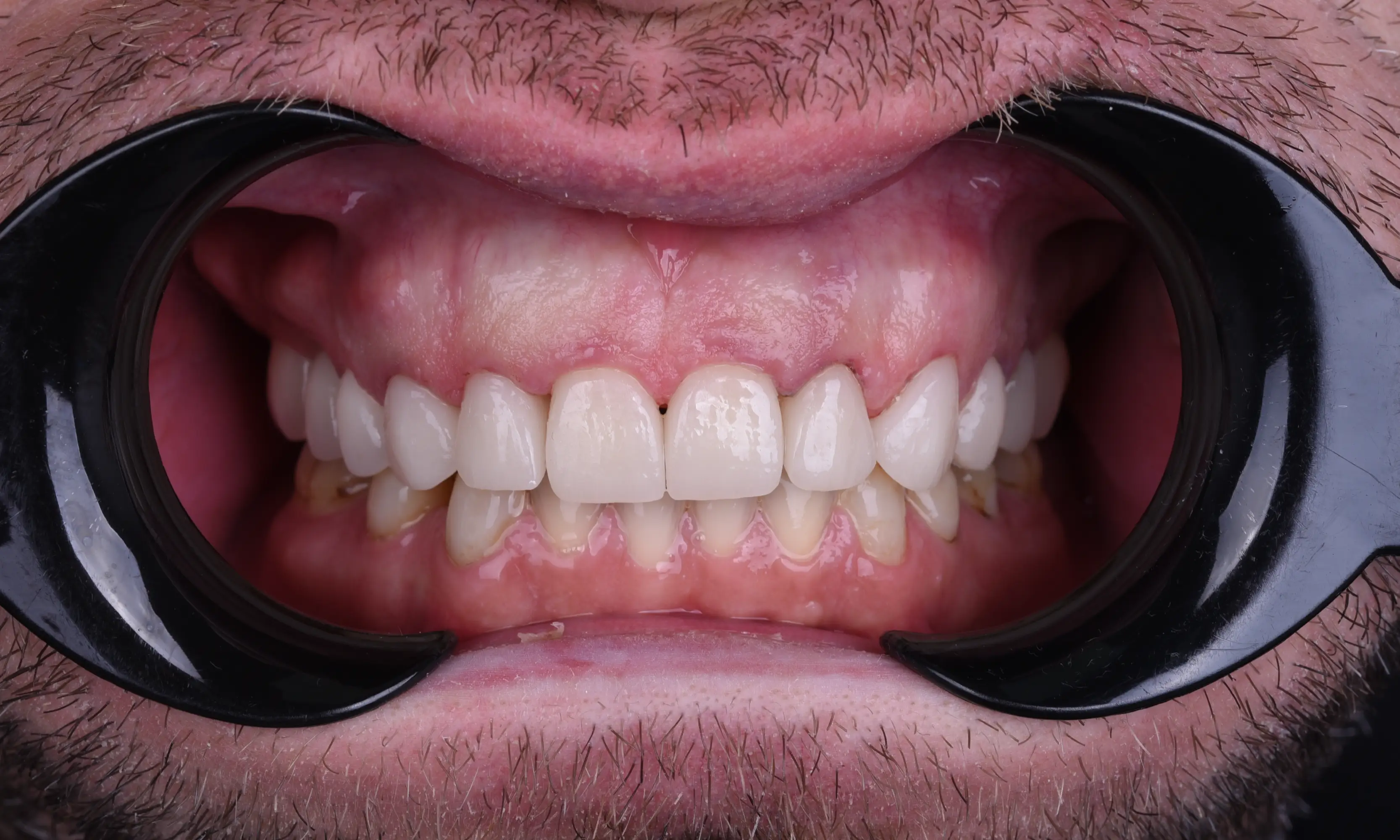 Tam Zirkonyum Sonrası - Vaka 64 - Milim Dental Hospital Bursa