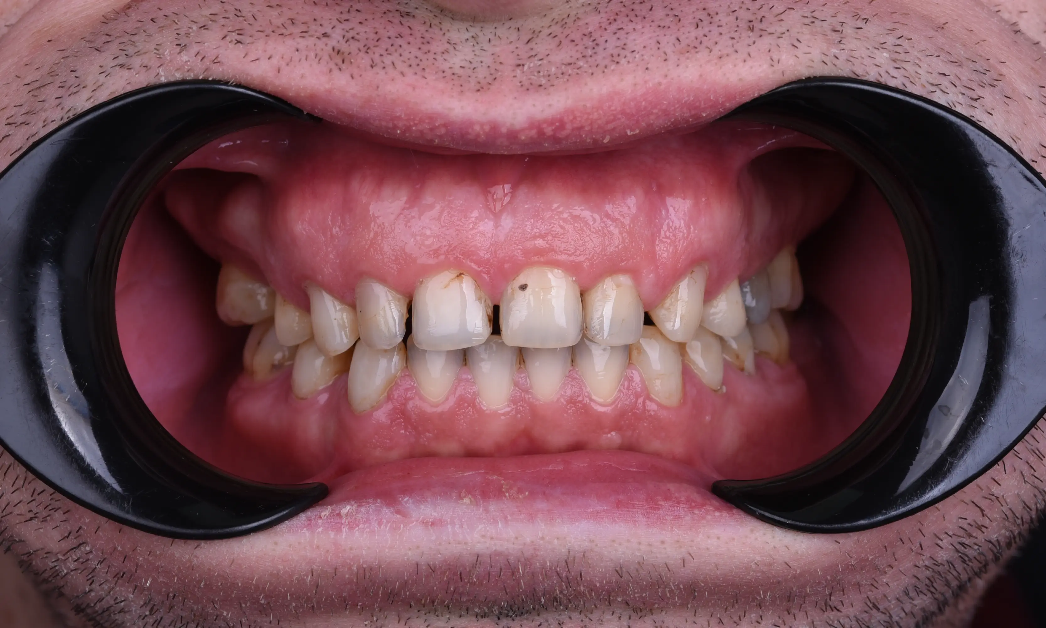 Tam Zirkonyum Öncesi - Vaka 64 - Milim Dental Hospital Bursa